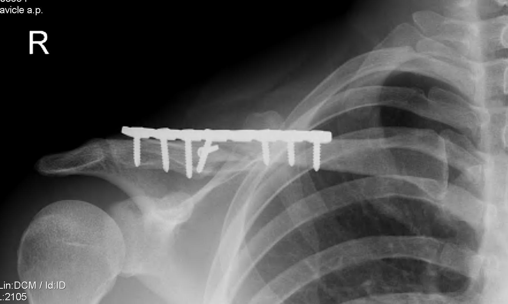 Clavicle Plate